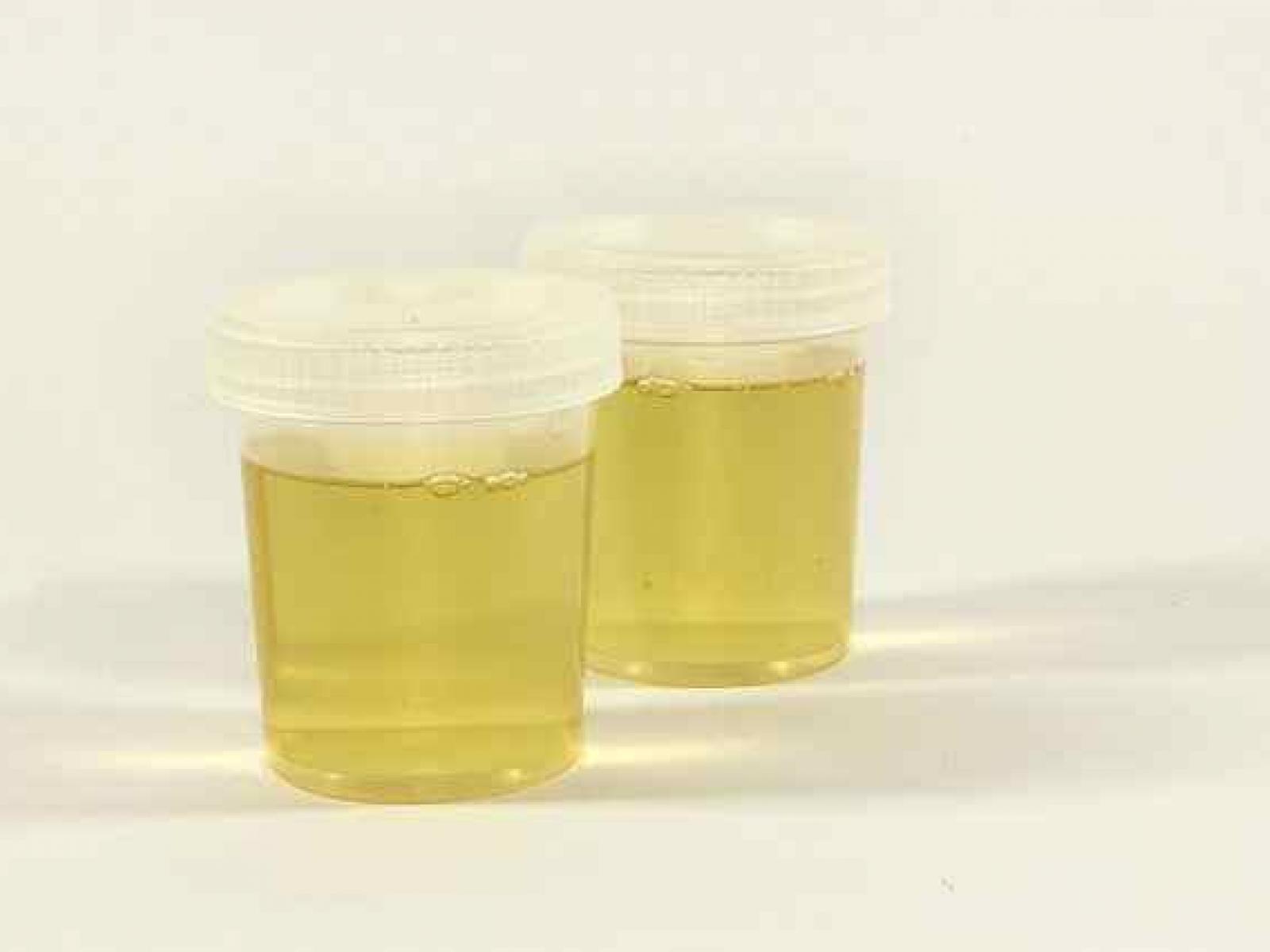Jars of urine